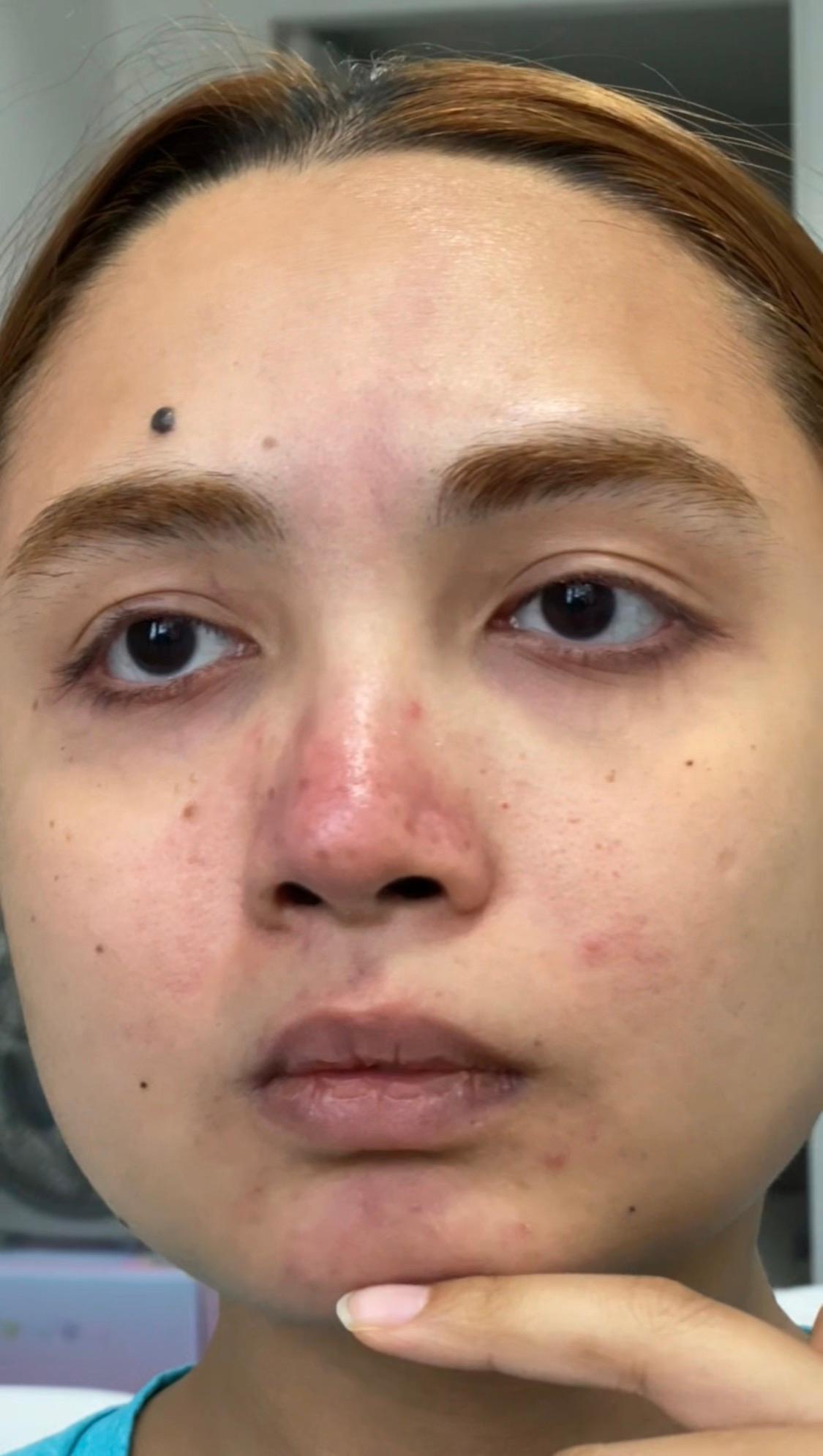 Woman showing skin imperfections close-up